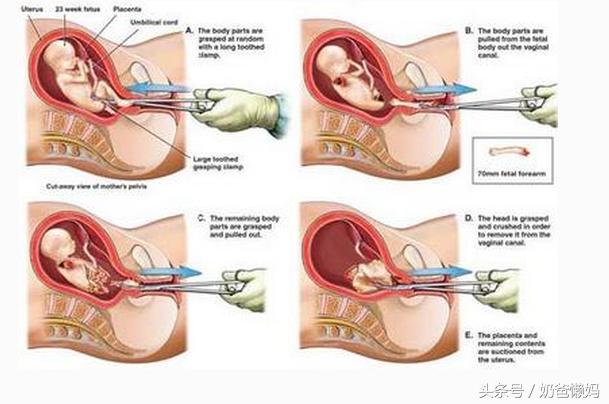 女人生孩子开几指才能顺产,生孩子骨缝开几指能生
