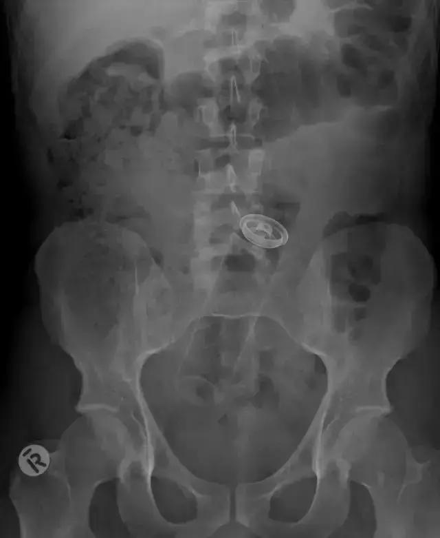 X光片里的体内异物，简直大开眼界