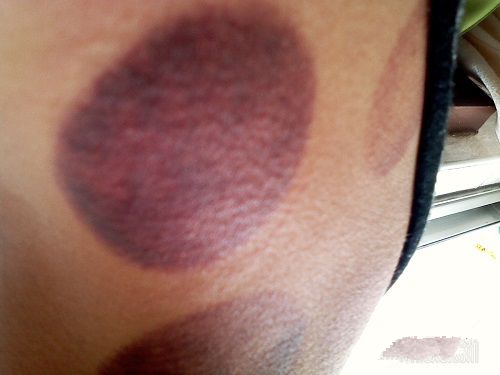 怎么通过拔罐的颜色判断身体状况,肩膀拔罐后颜色黑紫是怎么回事