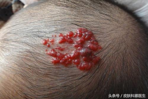 宝宝身上长了血管瘤要怎么治疗,肝上长血管瘤0.7x0.8要不要治疗