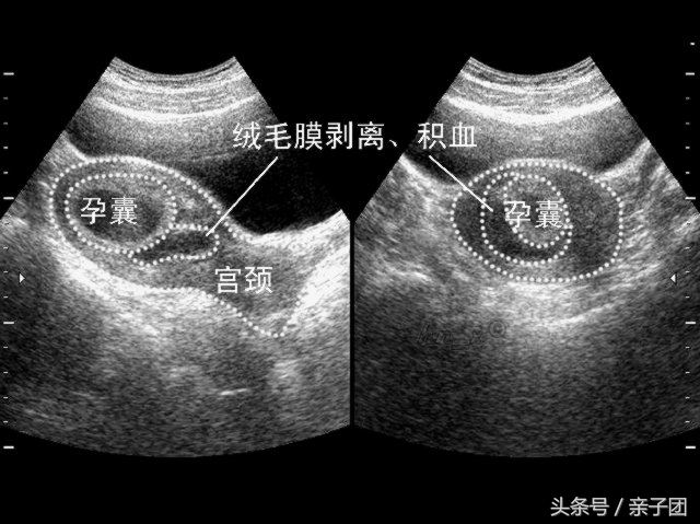 孕早期反复出血是什么原因引起的,孕早期出血可能是什么原因导致