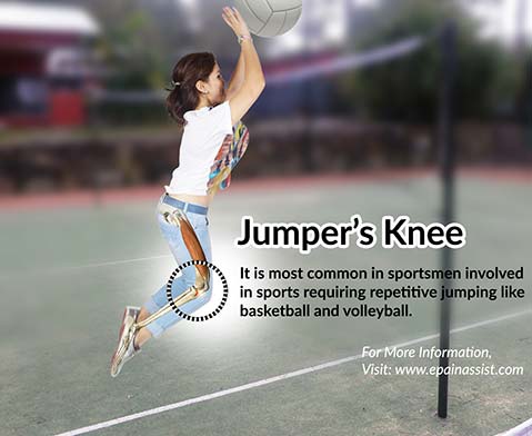 运动后修复膝盖喷雾,膝盖长期运动受损怎么办