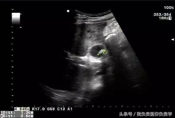 楂樻墜杩涢樁鑵拌吂璁粌,鑳嗗泭缁撶煶绌垮瓟鐥囩姸