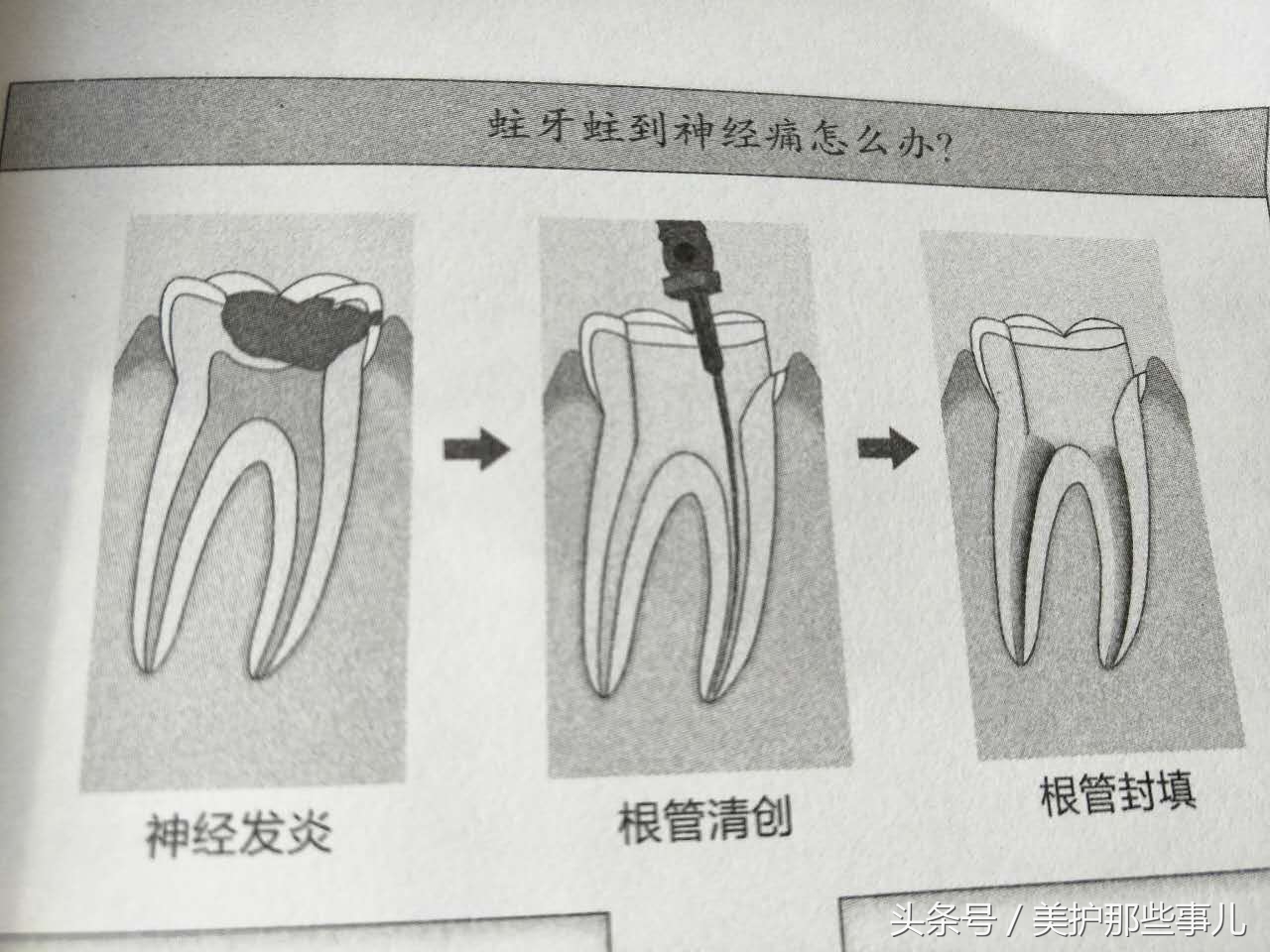 蛀牙怎么知道龋坏到牙神经了,蛀牙痛到神经怎么办