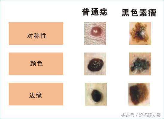 黑痣癌变一般是一个痣还是好多,黑痣在什么位置容易癌变