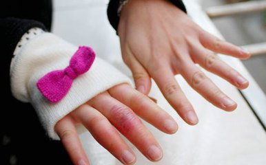 冻疮族的福音！预防冬季冻疮有妙法！