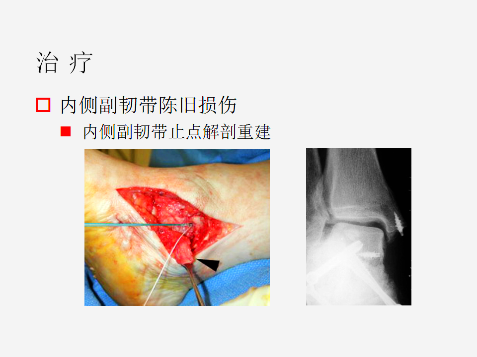 脚崴了怎么办判断是否骨折,脚崴了怎么办视频
