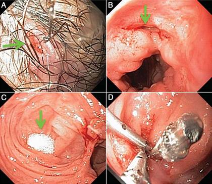 克罗恩病内镜严重程度指数,克罗恩病内镜检查是怎么样的