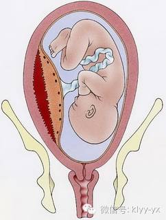 生活方式孕期腹痛很着急，读懂它对症处理不是事！