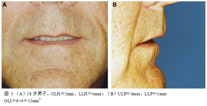 欧洲、亚洲、非洲丰唇标准及注射剂量