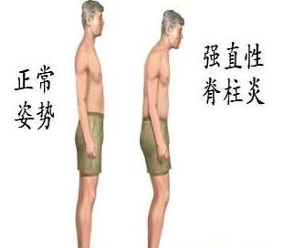 强直性脊柱炎呈竹节状恢复训练,强直性脊柱炎的中医治疗原则