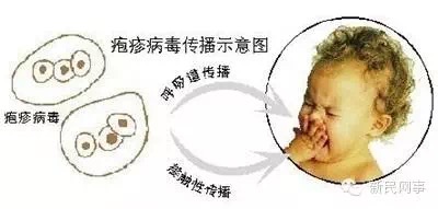 疱疹性咽峡炎可以吃什么药预防,小儿疱疹性咽峡炎的治疗