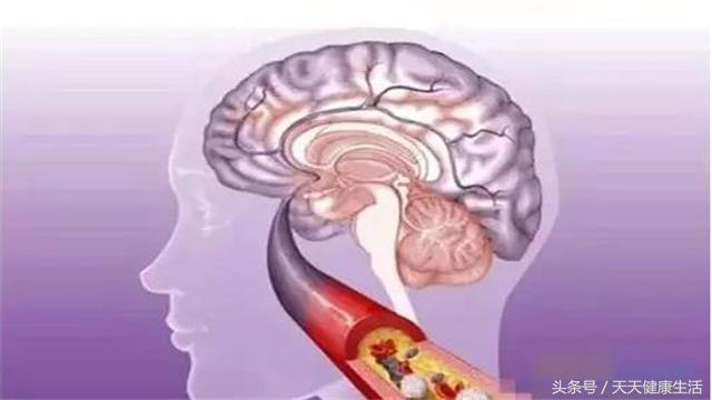 脑血栓呛咳,呛咳脑梗