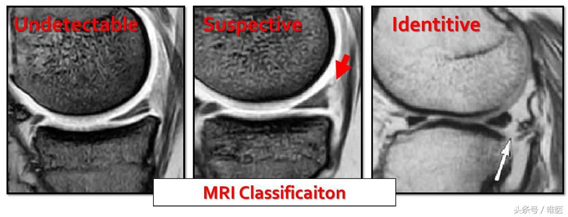 膝关节内侧后角半月板1度损伤,右膝关节内侧半月板后角变性损伤