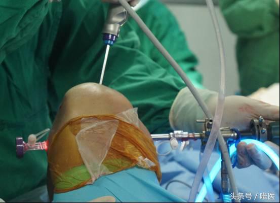 膝关节内侧后角半月板1度损伤,右膝关节内侧半月板后角变性损伤