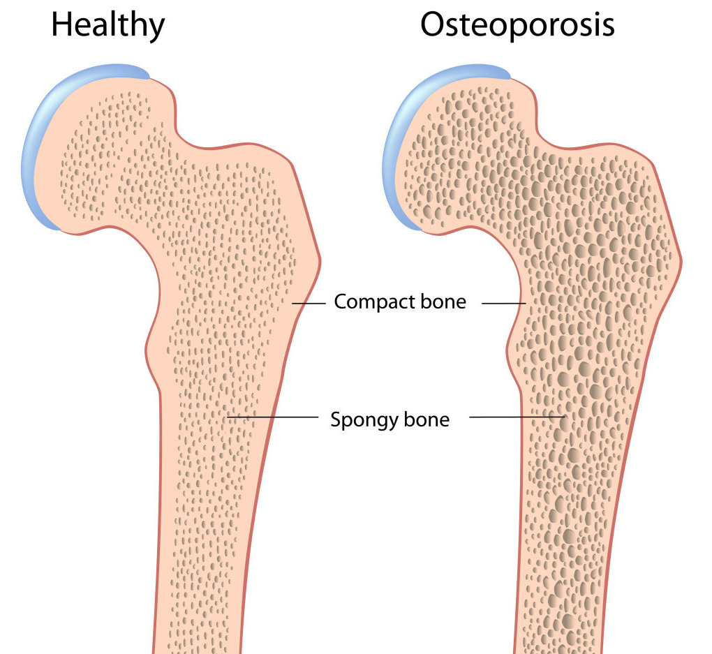 人到中年后骨质疏松要怎么治,中老年人骨质疏松该怎么办