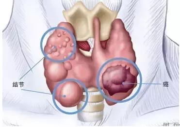 甲状腺结节是滤泡性癌吗,甲状腺结节是甲状腺炎引起的吗