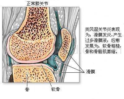 类风湿疼痛缓解小偏方,类风湿晚期疼痛难忍有溃烂