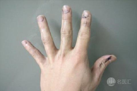 灰指甲的不同治疗方法比较