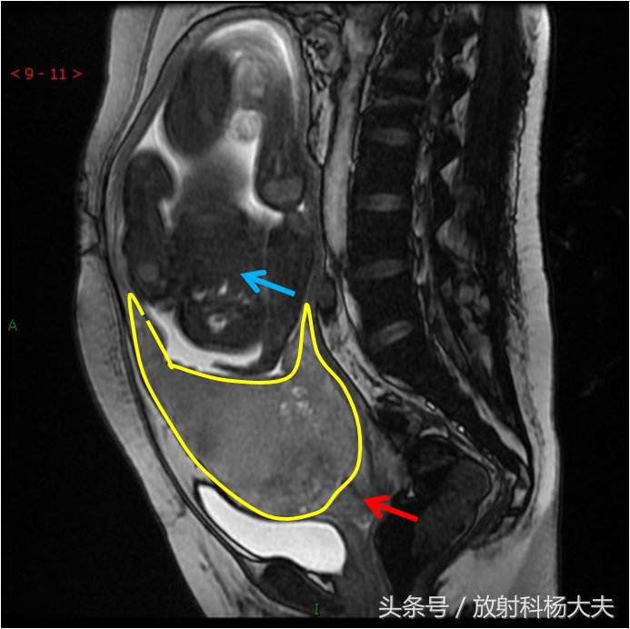 胎盘离宫颈口2厘米叫前置胎盘吗,怀孕后壁胎盘却是前置胎盘咋回事