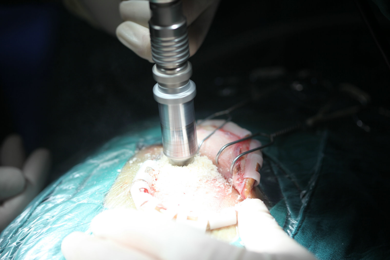 神经外科纪实视频,显微神经外科手术费用