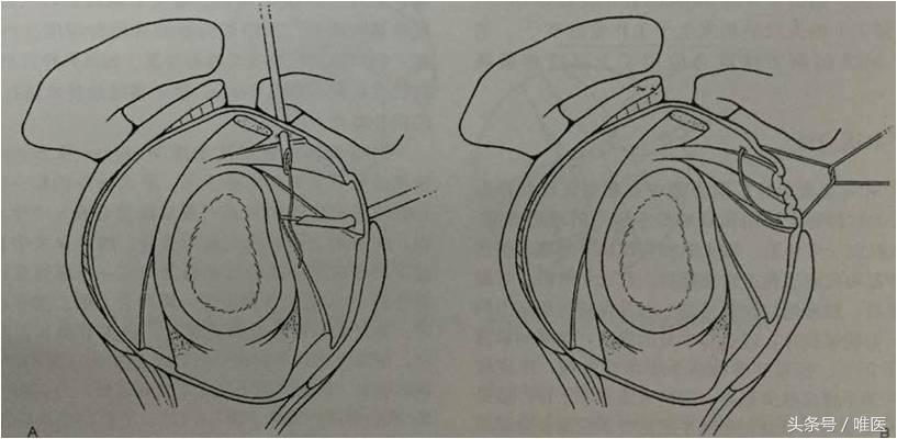 肩关节镜修复方法,肩关节镜下半骨道修复技术