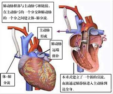 新生儿肺动脉闭锁治疗方案,室间隔缺损合并肺动脉闭锁定义