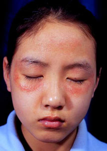 皮肤湿疹为什么这么难治愈,一定要从根源解决皮肤湿疹问题