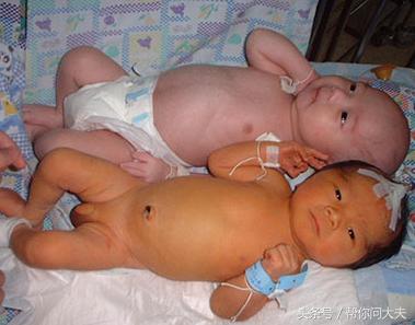 病理性黄疸有没有生命危险,得过黄疸的小孩后期皮肤会发黄吗