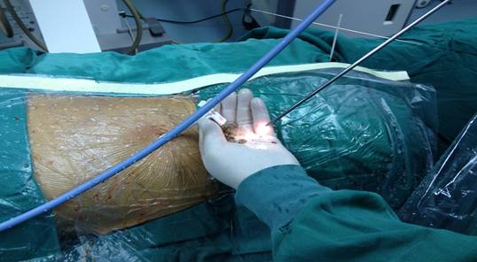 微创肾镜下肾结石碎石取石术,经皮肾镜肾结石激光碎石全过程