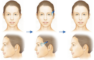 自体脂肪丰太阳穴和玻尿酸哪个好,为什么玻尿酸填充越多越持久
