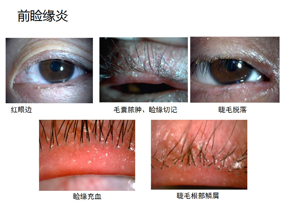 眼睑缘炎的发病原因,眼睑炎的症状和治疗方法