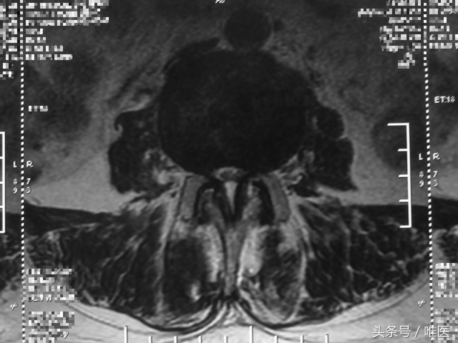 退行性腰椎管狭窄的治疗方法,腰椎管狭窄症初期症状