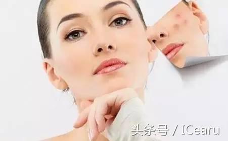 脸颊下巴祛痘有效方法,最实用的脸部祛痘方法