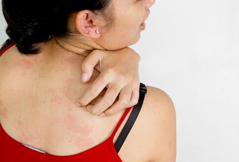 真菌感染皮肤会起小疙瘩么,真菌感染像粉刺一样的疙瘩