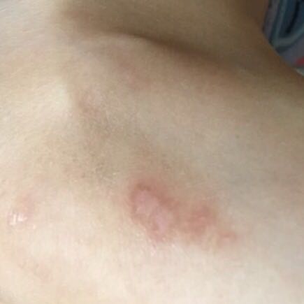 推荐一下最有效的祛疤膏,推荐一款祛疤膏