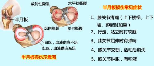 半月板平时注意事项怎样恢复更快,半月板检查需要注意什么
