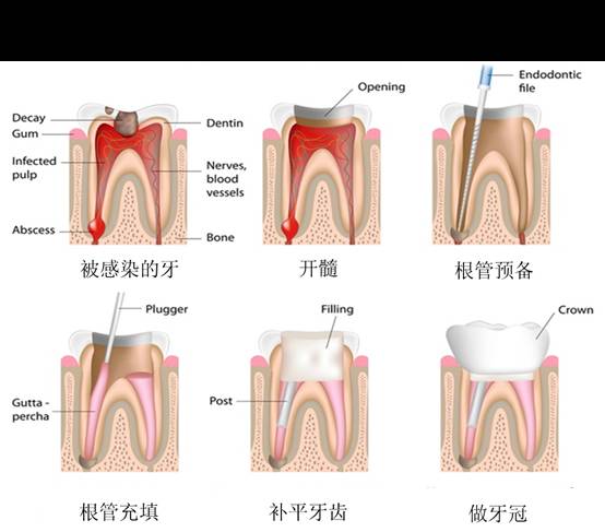 乳牙蛀了需要去拔吗,乳牙蛀了需要治疗吗