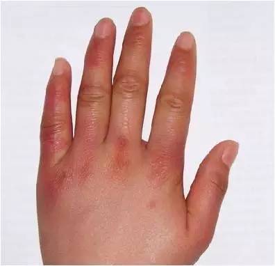 冬天生冻疮怎么办简单方法,冬天长冻疮是因为太冷了吗