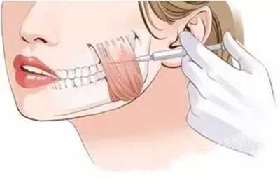 你一年要在脸上花多少钱,打瘦脸针是不是600块钱一支