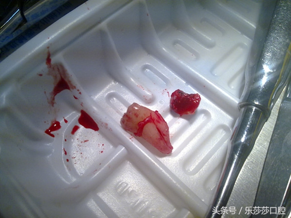 小孩可以下午拔牙吗,为什么下午不能拔牙迷信的说法