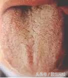 中医舌诊图谱100例,靠谱中医史上最全高清舌诊图谱