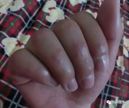 儿童脸上冻疮怎么处理,儿童冻疮怎么快速治疗最快最有效