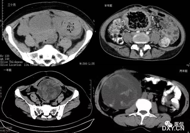 消化系统钡餐造影的直接征象,消化系统影像学诊断手册基础知识