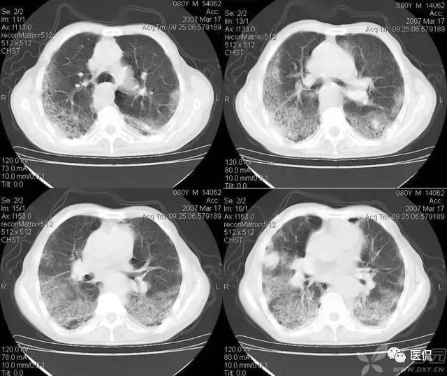 影像学呼吸系统理论知识,呼吸系统疾病影像学常见征象