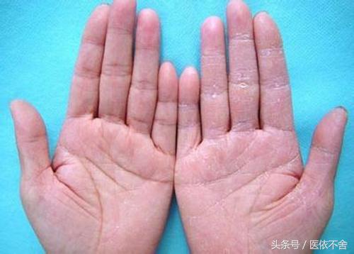 天气冷手脚干裂怎么办,秋冬季节手脚干裂用啥药