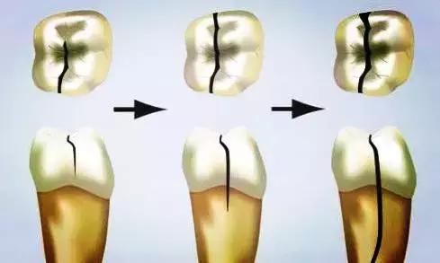 蛀牙牙疼怎么缓解最有效方法,没有蛀牙为什么也会牙疼