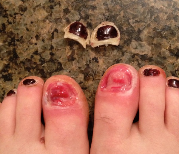 跑步脚受伤的日子该怎么保持状态,常见的跑步膝伤病症状