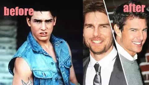 整牙=整容?看杨幂、刘涛、高圆圆为你亲身示范!