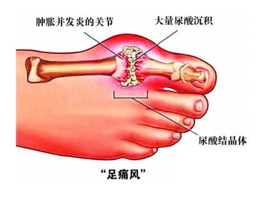 痛风急性发作期服用西芹籽 (年轻的痛风患者能长期吃西芹籽)